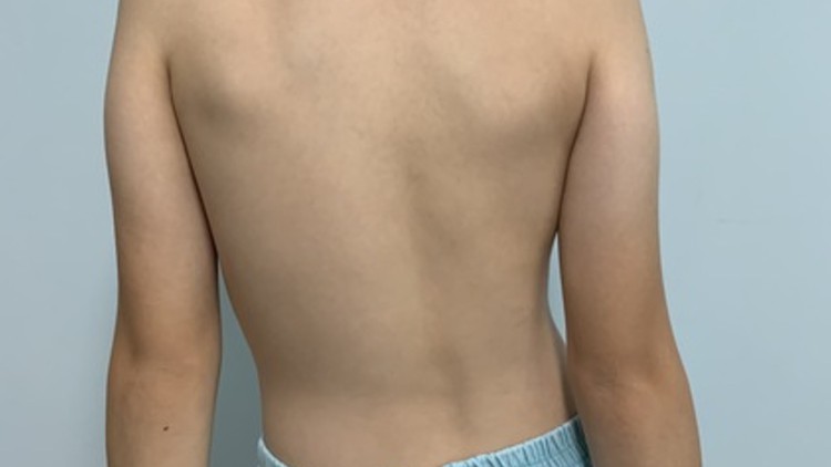 Read more about the article Scoliosis Management Online Course