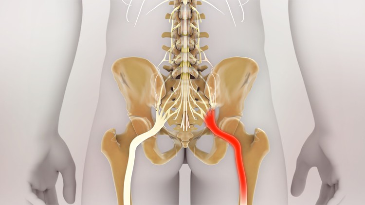 Read more about the article How to fix Sciatica at home?