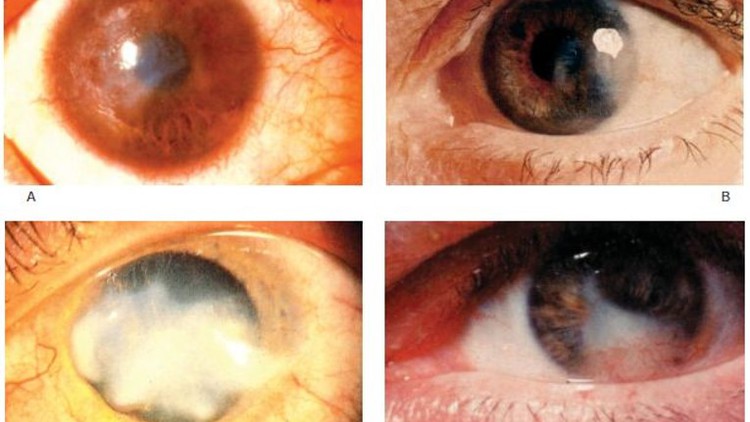 Clinical Approach to Corneal Opacity