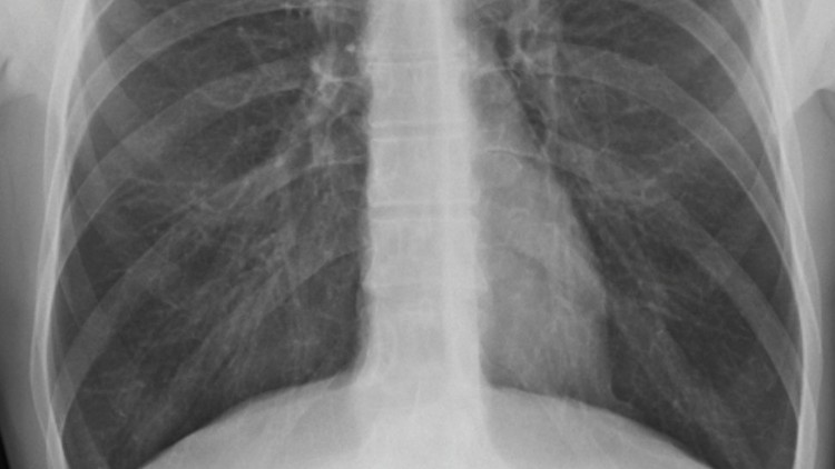 CASE HISTORY Young patient with Chest pain & breathlessness