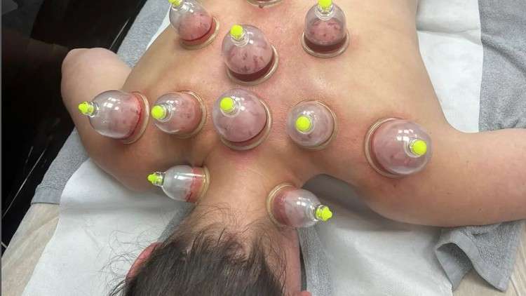 Read more about the article Professional Hijama and dry cupping therapy course