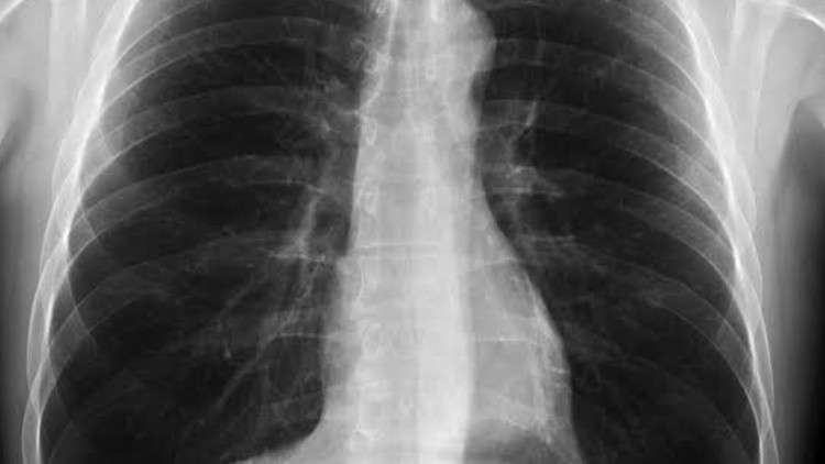 Read more about the article LEARN X RAY CHEST INTERPRETATION – FOR ALL DOCTORS, MED STUD