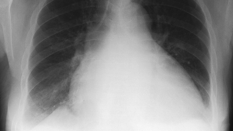 Heart Failure & Hypercholesterolemia: Case Based Discussion