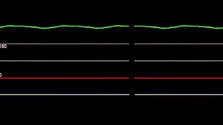 Asystole : Introduction causes symptoms & Management