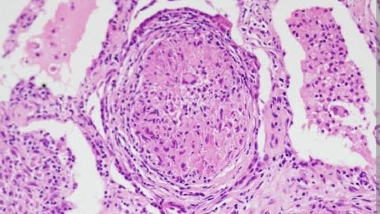 Sarcoidosis : A case based Discussion