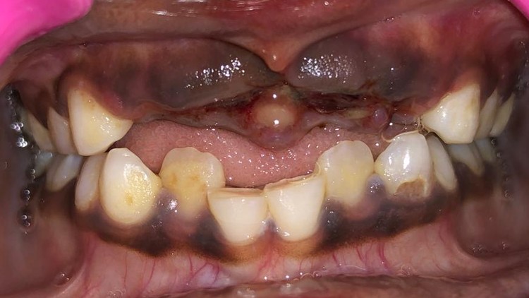 Read more about the article Dental Avulsion: Emergency Management and Clinical Care
