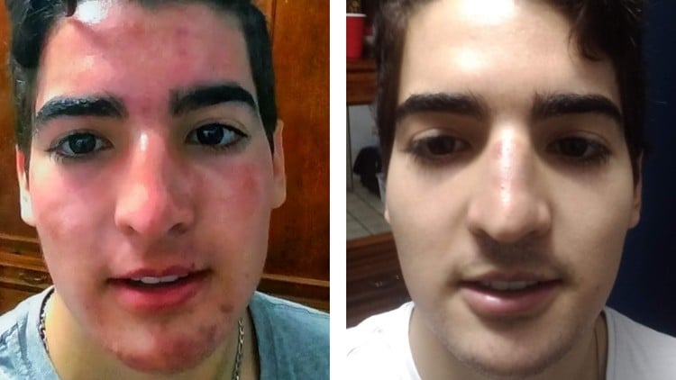 Acne: Effective Solution from the Root